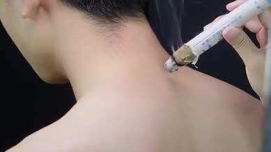 4K实拍中医艾灸男子背部艾灸操作画面素材视频的预览图